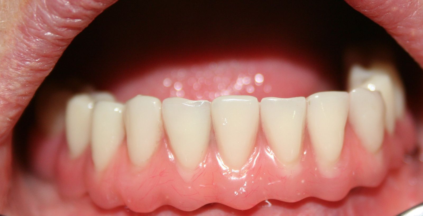 Overdenture