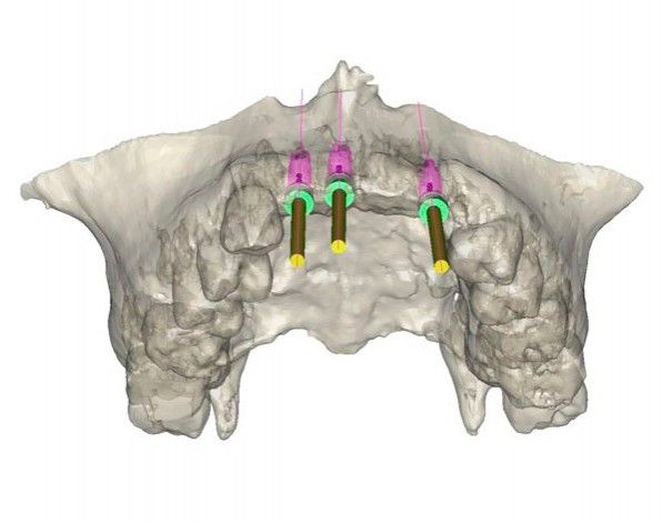 Implant planning