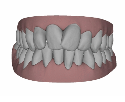Tooth movement with orthodontics