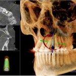 planificacion implantes